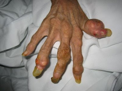 Hand of a 46yearold anorexic woman