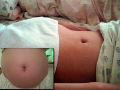 abdominal bloating, purging, bulimia