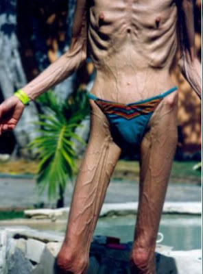 anorexic older woman, bikini