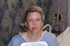 BICYCLE ACCIDENT January 17th 2009