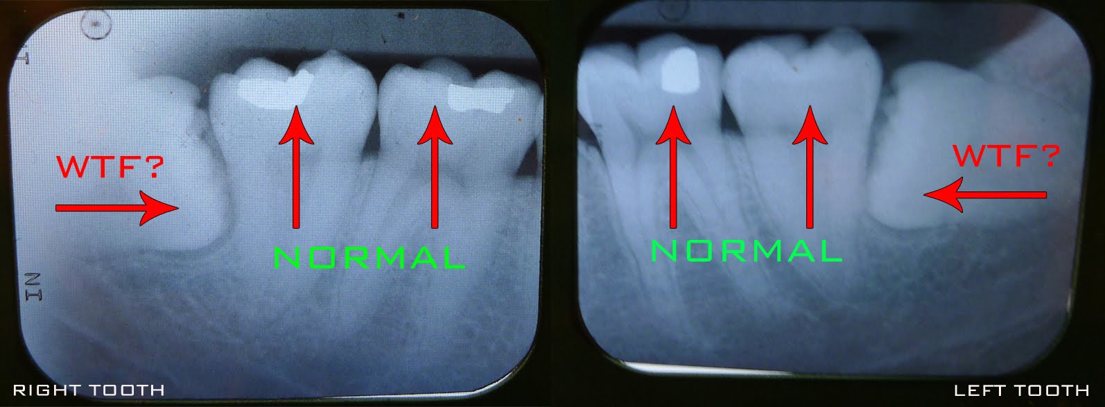 My Wisdom Teeth