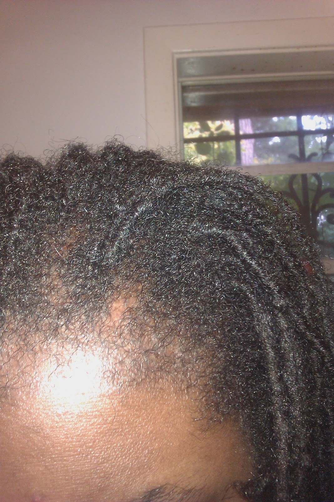 Difference Between Nits And Dandruff to Pin on difference between nits and dandruff AdRkZB1SZTuU7S8RDTTygw9EdjntW 8fKujmbnbk5yb uuHCHv9ab7RRMvqUHMWipgF4IswOWexfP59AUhZXJg