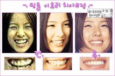 Lee Hyori Surgery