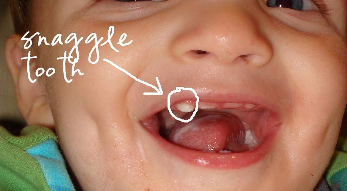 Momfessionals Snaggle Tooth