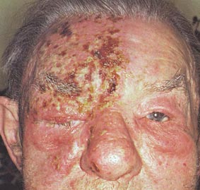 [shingles.jpg]