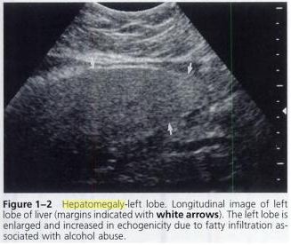 Ultrasound : Hepatomegaly