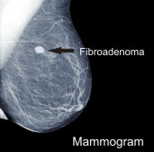 Fibroadenoma Breast Natural Treatment Fibroadenoma Breast Natural Treatment