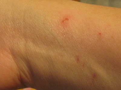 Miranda Lambert Buzz: poison ivy rash hands