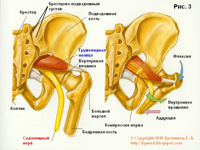 Синдром грушевидной мышцы