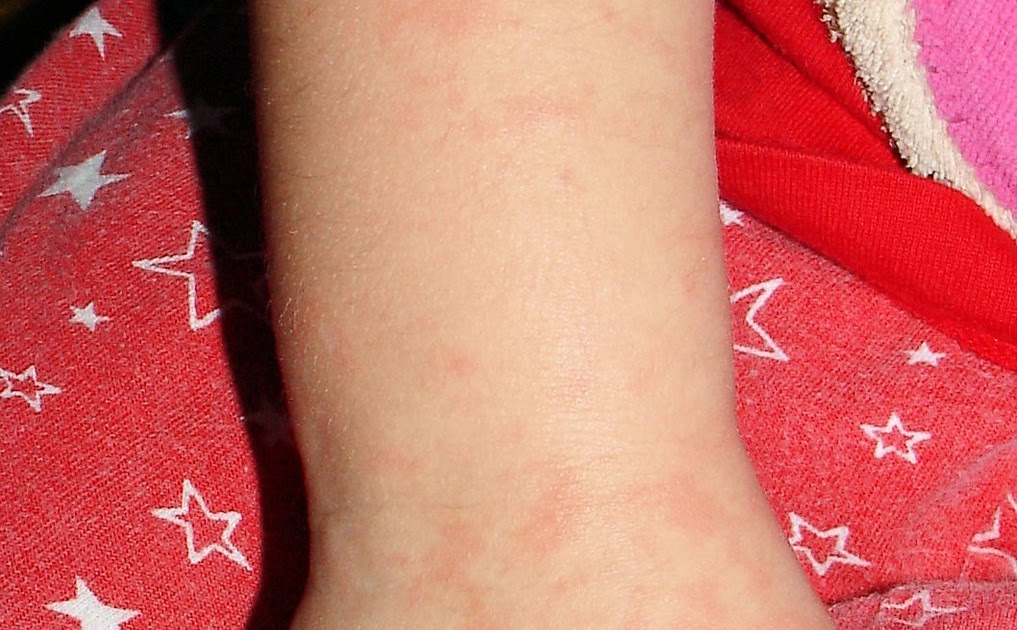 The Good Life Fifth Disease (Slapped Cheek Syndrome)