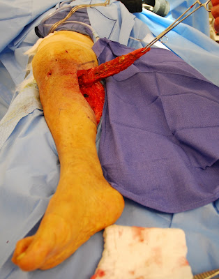 Plastic Surgery Flaps on Free Flaps   Hand Surgery  Flap Surgery  Gastrocnemius Flap