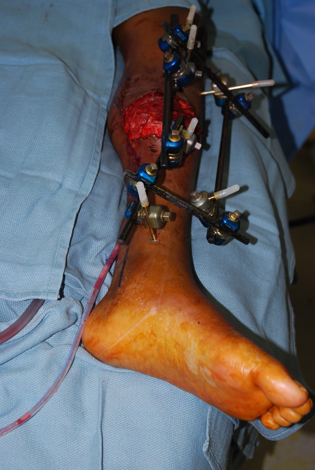 Flap Surgery: Autologous Tissue, Wounds, Microvascular Free Flaps