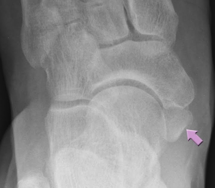 Roentgen Ray Reader Types of Accessory Navicular Bones