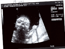 Cade's 18 Week Ultrasound