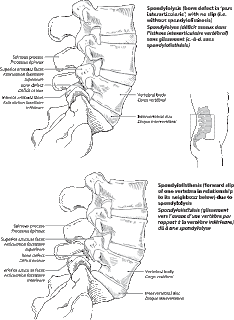 spondylolysis without listhesis spondylolysis without listhesis