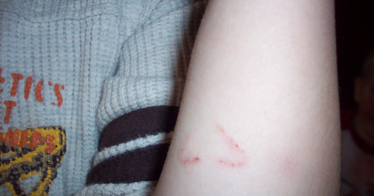 BUMMERFREE ZONE THIS IS WHAT AN ALLIGATOR LIZARD BITE LOOKS LIKE.