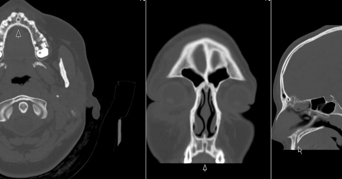 Radiology MRI Incisive Canal
