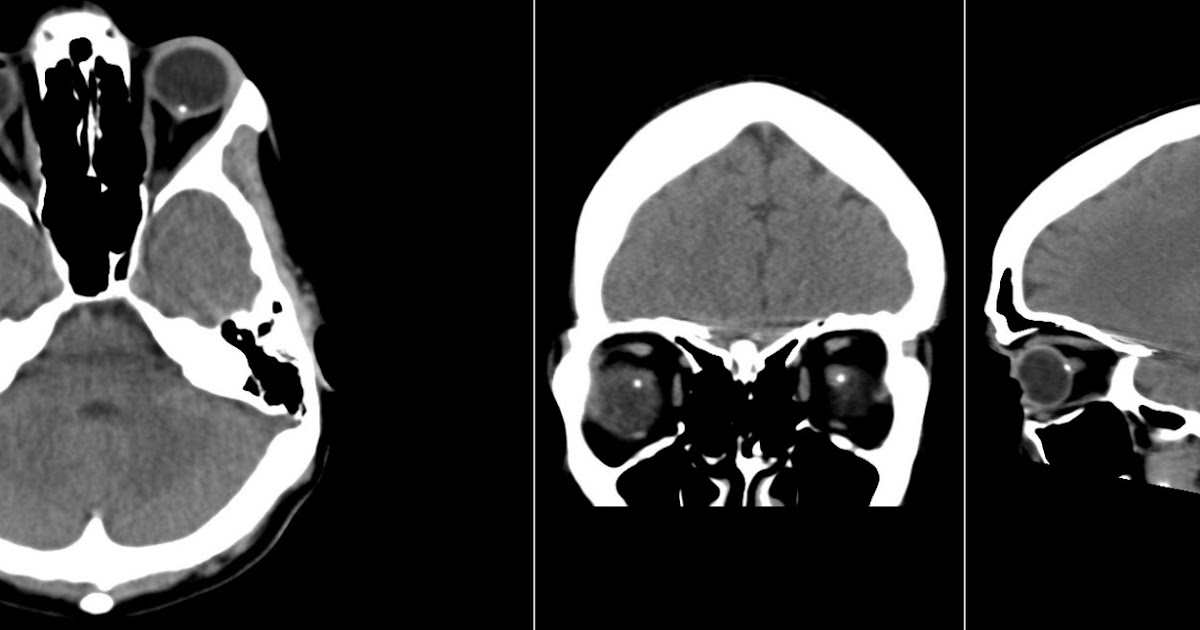 Radiology MRI Optic Disc Drusen