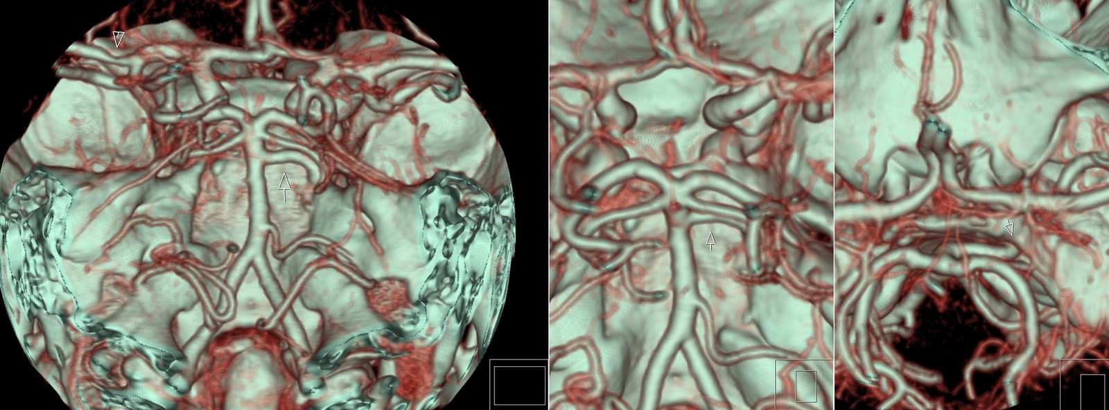 Cavum Velum Interpositum Cyst