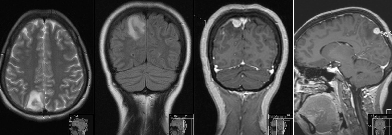 Cavum Velum Interpositum Mri