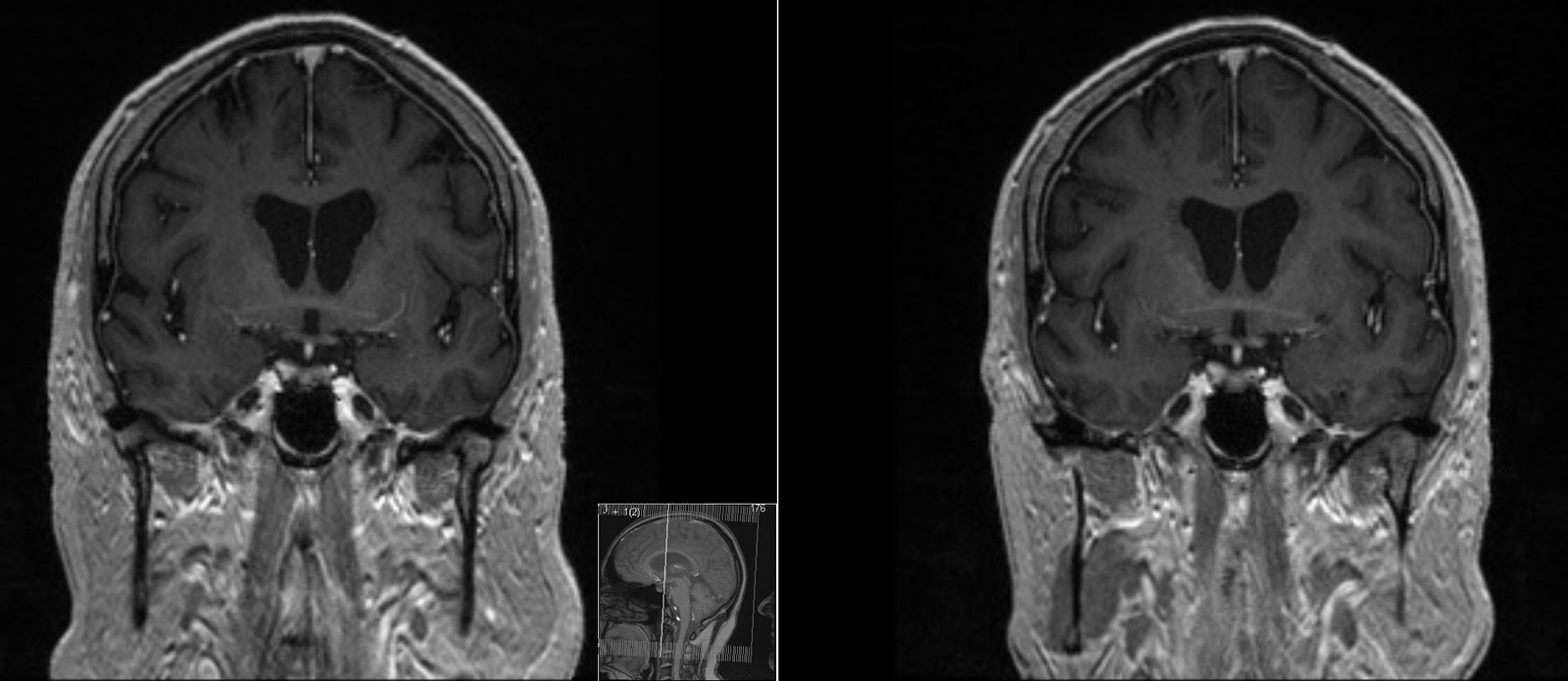 Radiology MRI Anterior Commissure