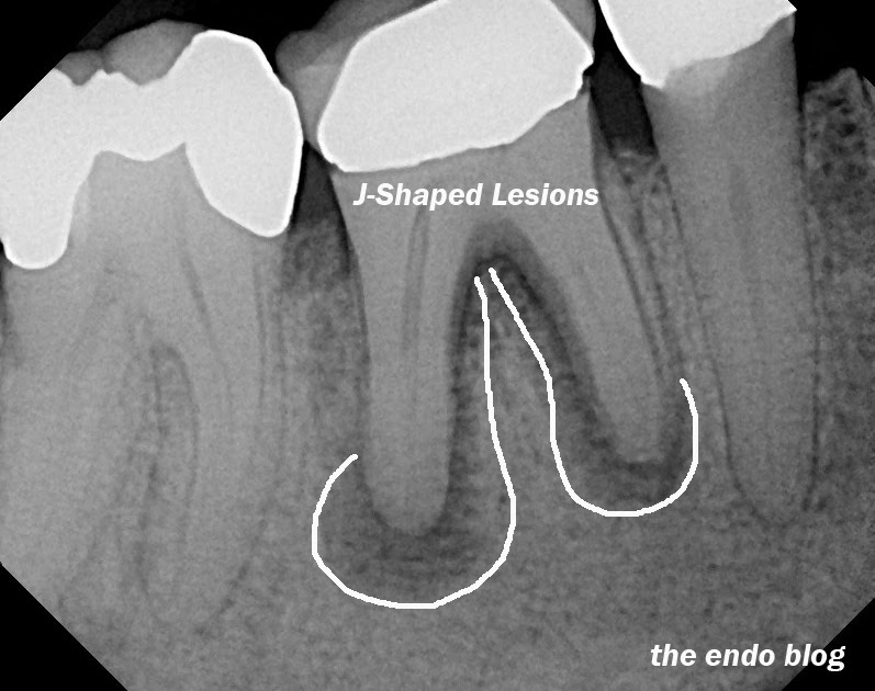 Endo Perio Lesion Radiographic at Becky Smith blog