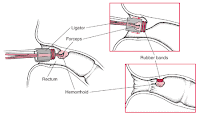 hemeroid banding pic