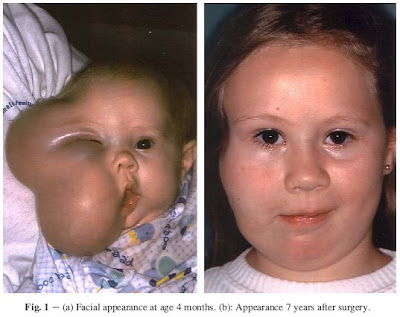 teratoma picture
