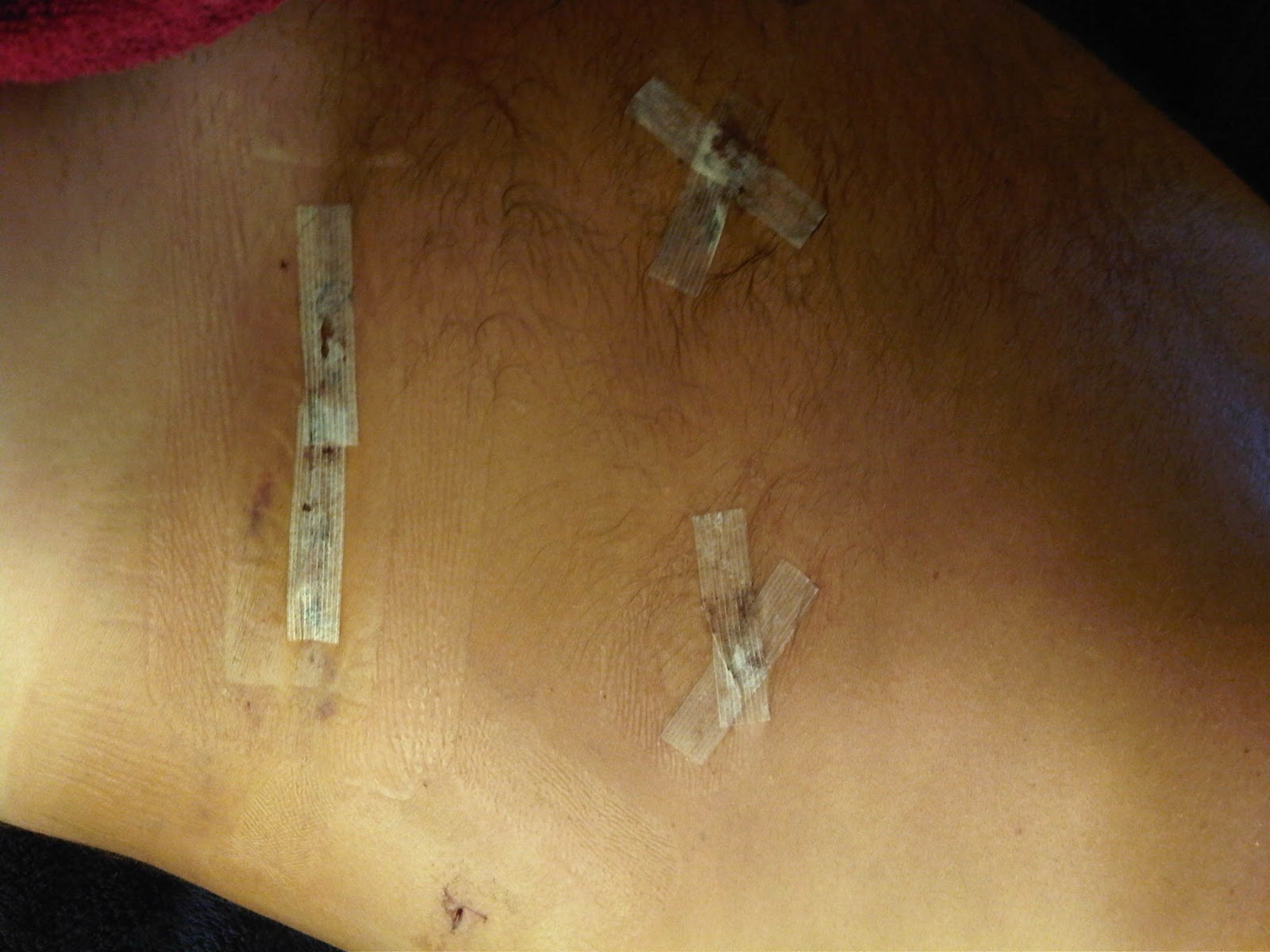 My live kidney donation