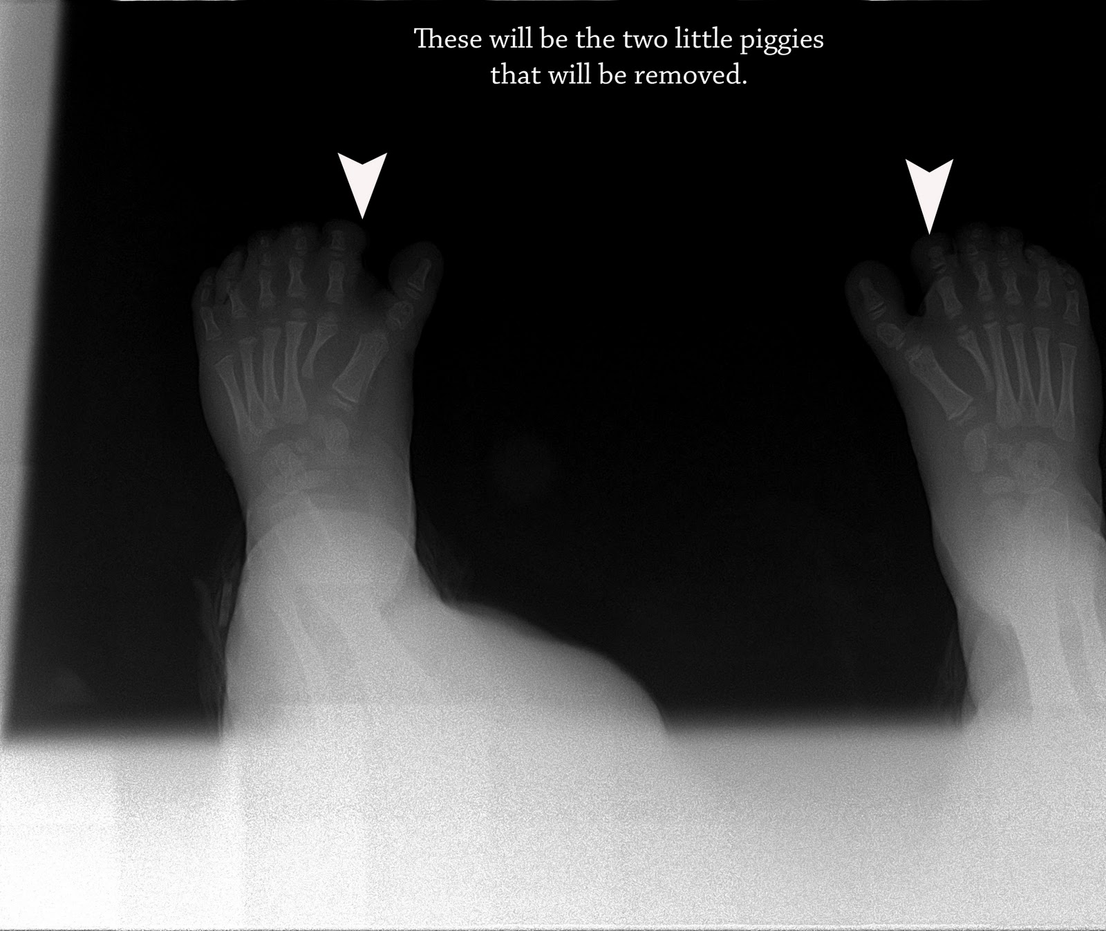 baby foot xray