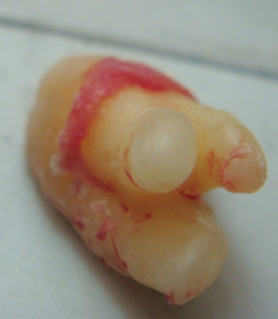 List 95+ Pictures Pictures Of Dissolvable Stitches In Mouth Excellent