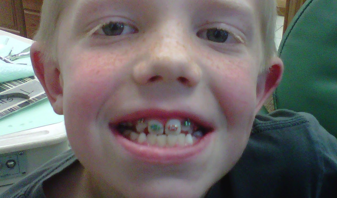 to Our Crazy Life! Braces!