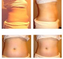 RF Tummy Slimming