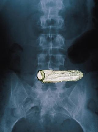 [X-Ray+condon.jpg]