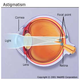 [astigmatism.jpg]