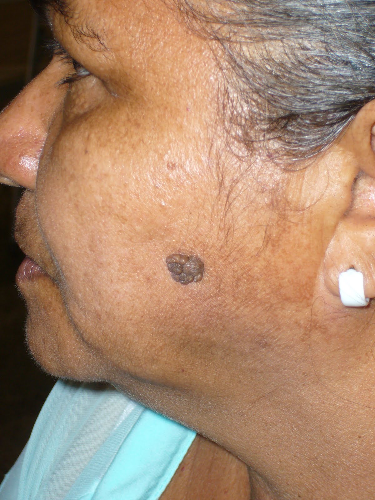 Face Mole