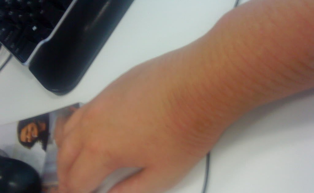 My Mobile Blog Crazy swollen wrist and hand