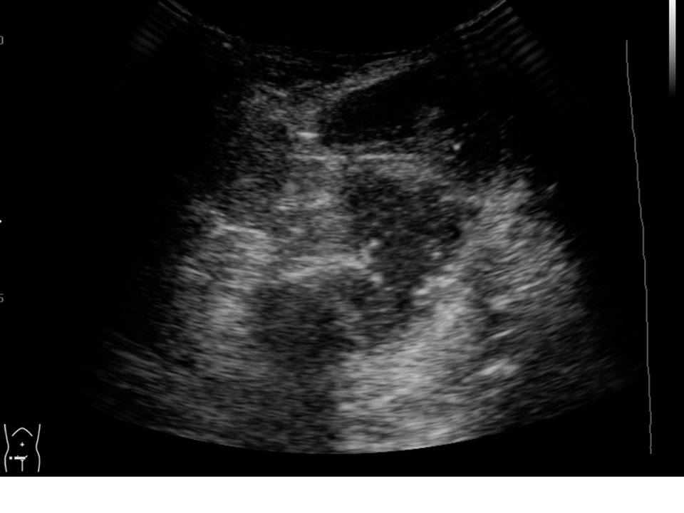 Inguinal Hernia Ultrasound Pictures to Pin on Pinterest of Cpt code for femoral hernia repair with mesh Inguinal Hernia Ultrasound Pictures to Pin on Pinterest of Cpt code for femoral hernia repair with mesh