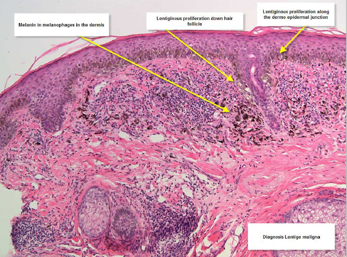 melanoma histology - pictures, photos