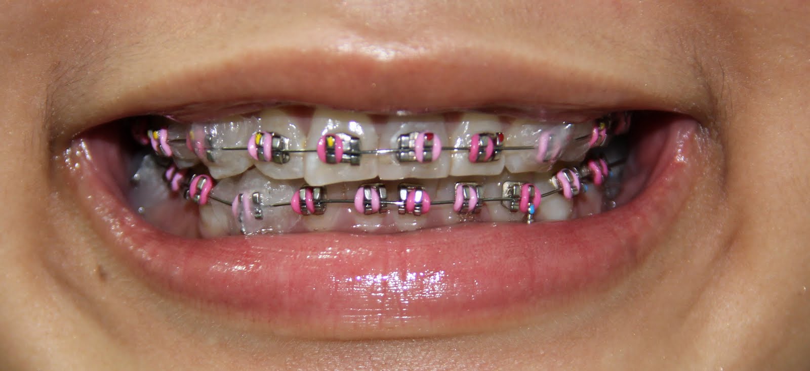 braces wax close put pokey bits gums cutting ve