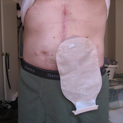 Picture Of Ostomy