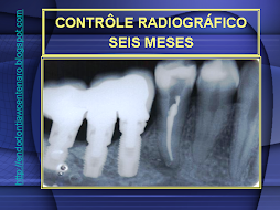 AINDA BEM QUE NÃO AFETOU O IMPLANTE