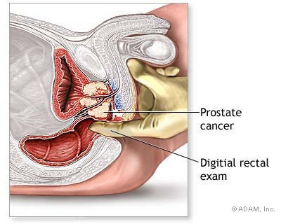 Images Prostate Cancer