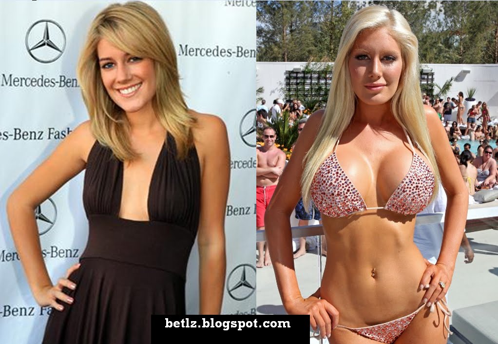 heidi montag before and after plastic surgery pictures. 2010 Heidi Montag before and