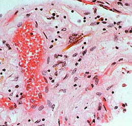 Lung Tissue With Asbestos Fibers