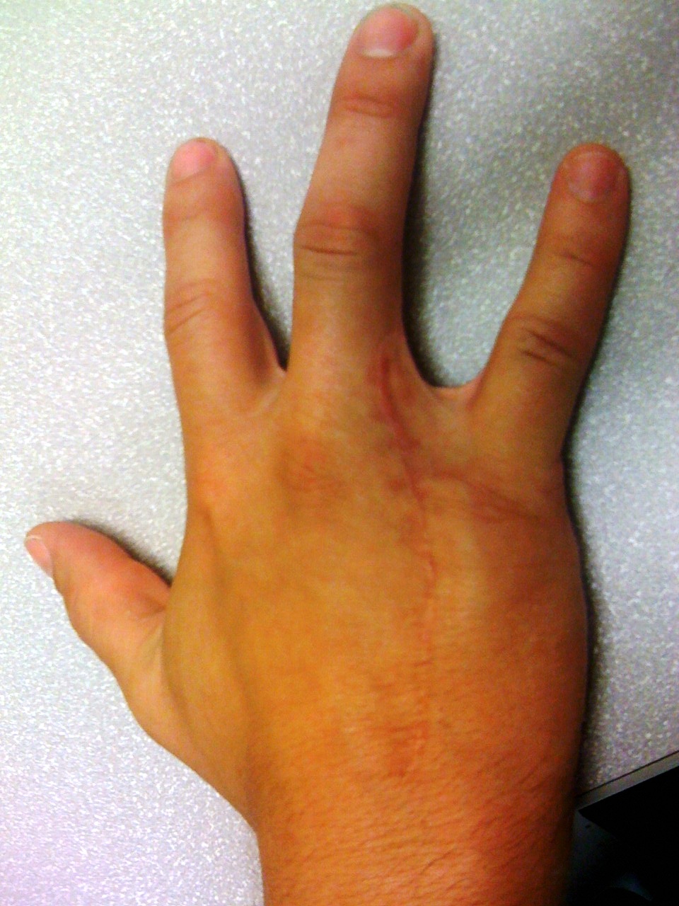 Ring Injury