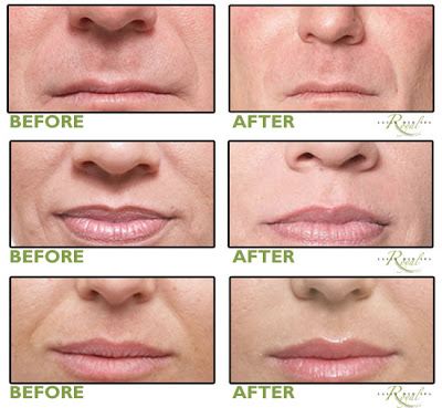 Juvederm Lip Fillers Before and After