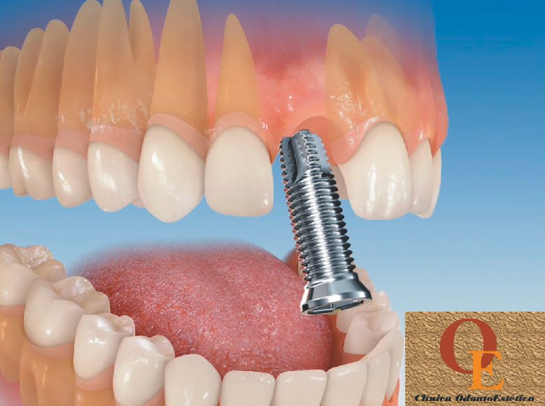 dientes postizos