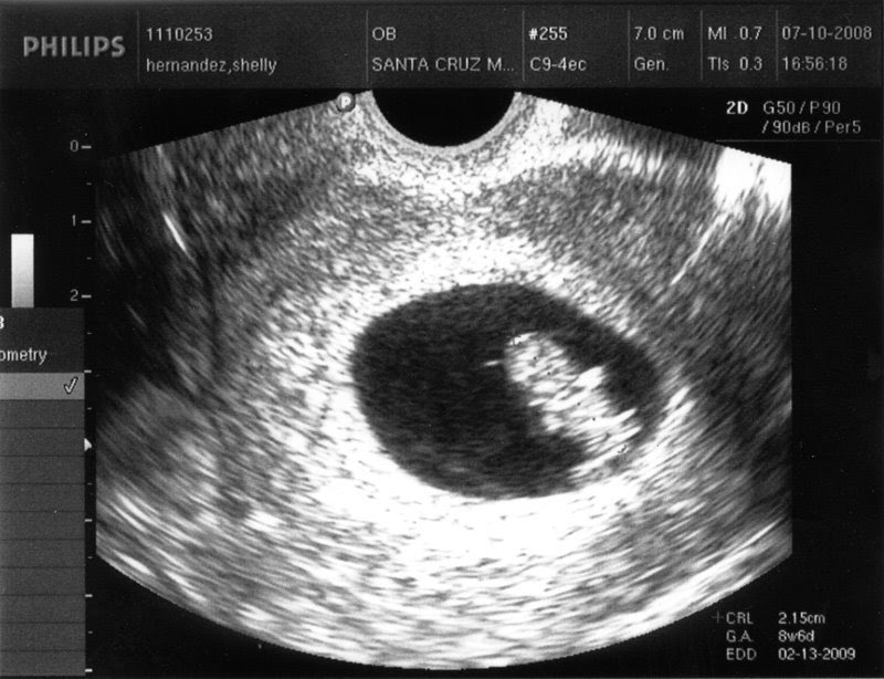 My Journey 8week ultrasound