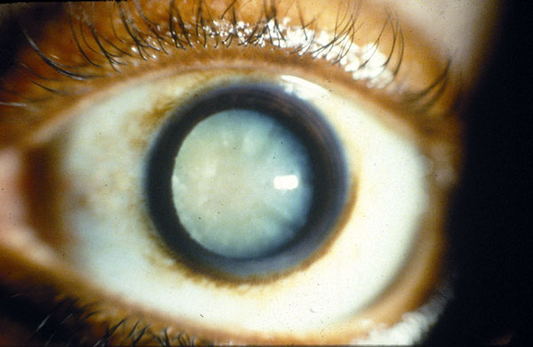 Cataract Eye